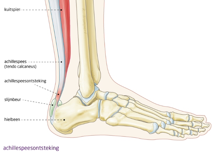 Achillespeesklachten