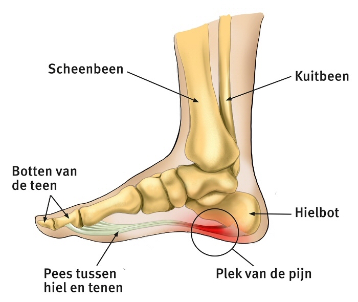 Fasciitis plantaris