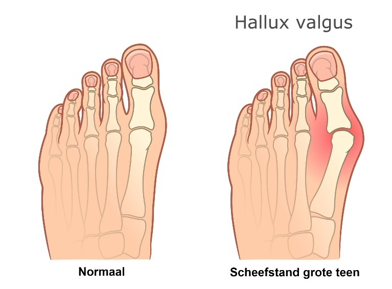 Hallux valgus