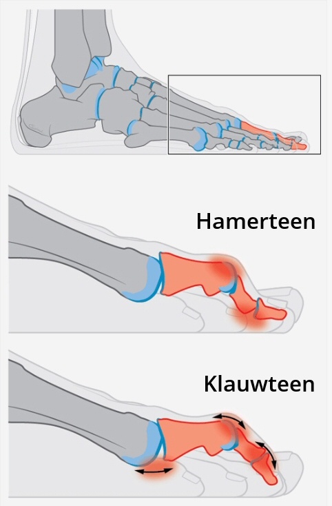 Hamer/klauwtenen