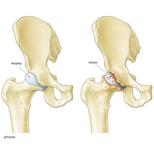 Heupartrose