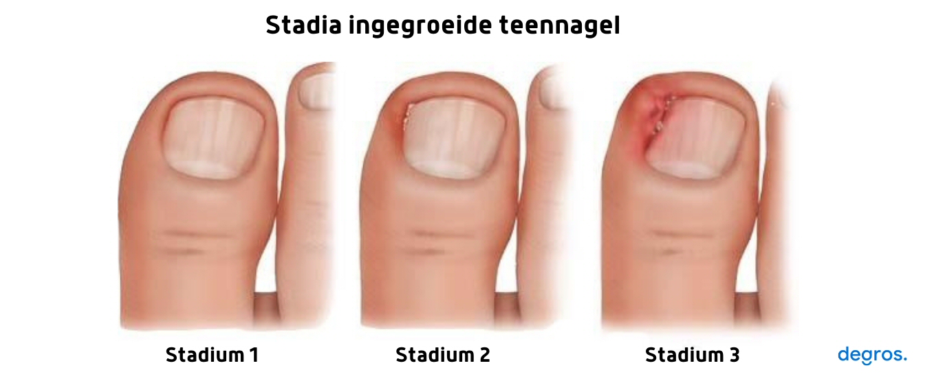 Ingegroeide nagel