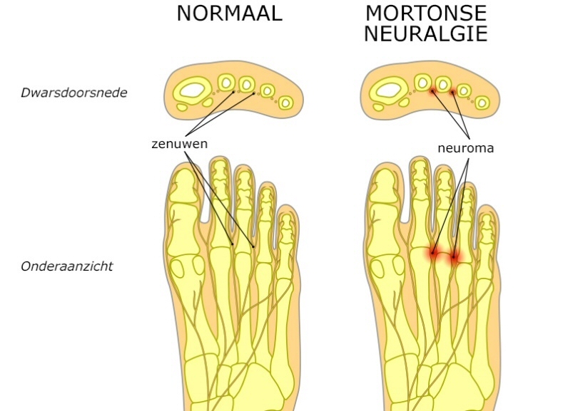 Mortonse neuralgie