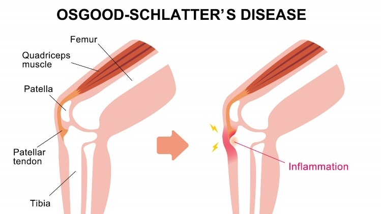 Osgood Schlatter