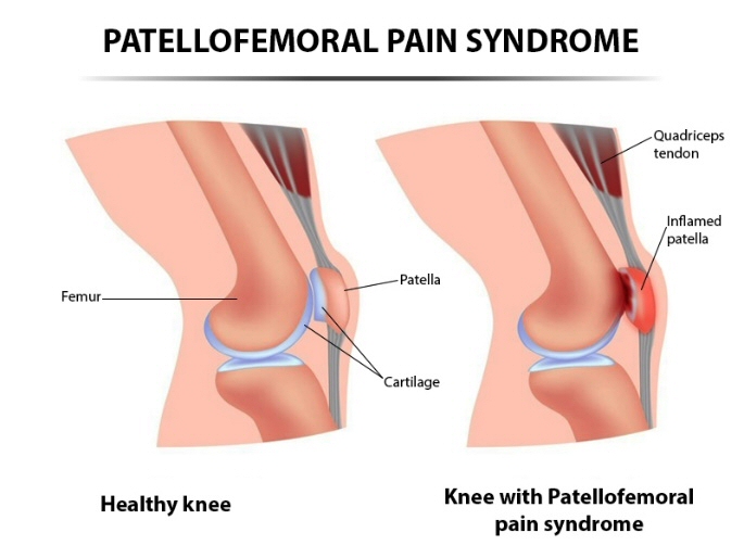 Patellofemoraal pijnsyndroom