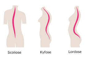 Scoliose – Kyfose - Lordose